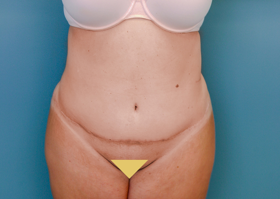 Abdominoplasty After Photo